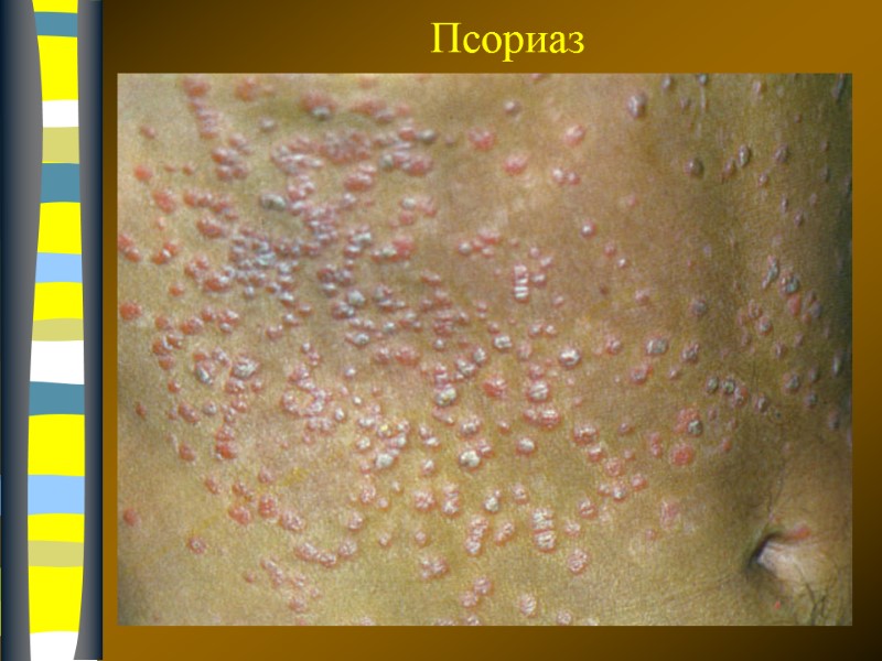 09.12.2017 Псориаз